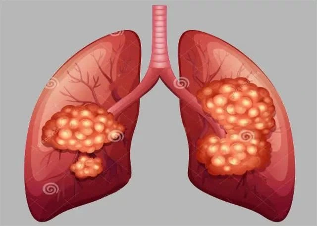 重庆肺癌老中医:吸烟导致肺癌的因素只是其一,还有这些罪魁祸首