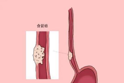 重庆中医肿瘤专家排名|这些食管癌的早期症状和预防方法大家要了解