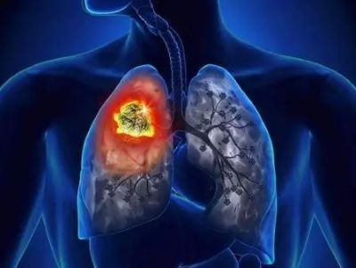 重庆中医肿瘤专家:肺癌复发的原因是什么?中医可以治疗吗