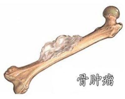 重庆市看骨癌靠谱的中医院是哪家?