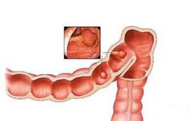 肿瘤医师罗登祥:男性肠息肉两年未复查危变肠癌，这些结肠癌信号要警惕！