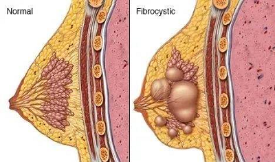 重庆中医肿瘤医师:发现乳腺肿瘤后,中医是怎么治疗的