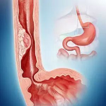 重庆中医肿瘤医师:结肠瘤患者如何进行中医饮食调理？
