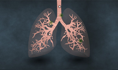 重庆肺癌中医院|如何及时在肺癌早期发现问题?中医治疗肺癌效果怎么样