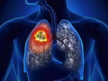 重庆中医肿瘤医院老中医:肺癌这种癌症具体是怎么患上的呢