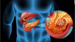 重庆胰腺癌肿瘤中医医师:早期发现胰腺癌才是治疗的比较好方法