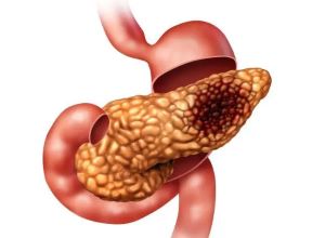 重庆治疗胰腺癌中医医师:胰腺癌高发群体竟然与这个有关