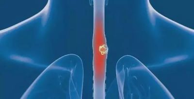 重庆中医治疗食管癌老中医:你知道吗?原来食管癌也会遗传