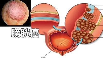 重庆中医肿瘤医院排名|尿尿出血这个症状要注意,有可能是得了膀胱癌