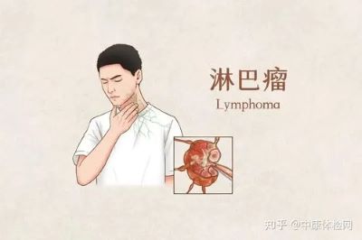 重庆中医肿瘤医师:为防止淋巴癌发病平时应该多吃蔬果少熬夜