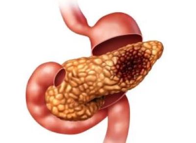 重庆中医治疗胰腺癌医师:比较常见的胰腺癌患者症状有哪些