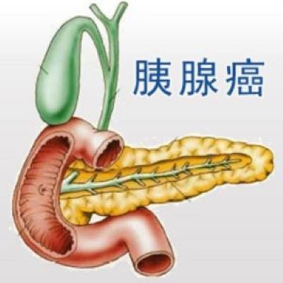 重庆中医肿瘤医院排名|牢记这些诱发胰腺癌发病的病因