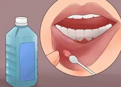 重庆中医肿瘤医院排名|口腔癌的病因,早期有哪些明显症状
