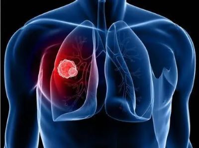 肺癌早期有哪些表现?又该怎么预防呢