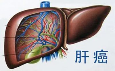 你知道肝癌有那些危害吗?下面老中医罗登祥带你看一看