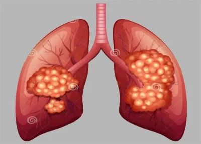 肺腺癌患者的疼痛有什么特征心慌又是为哪般
