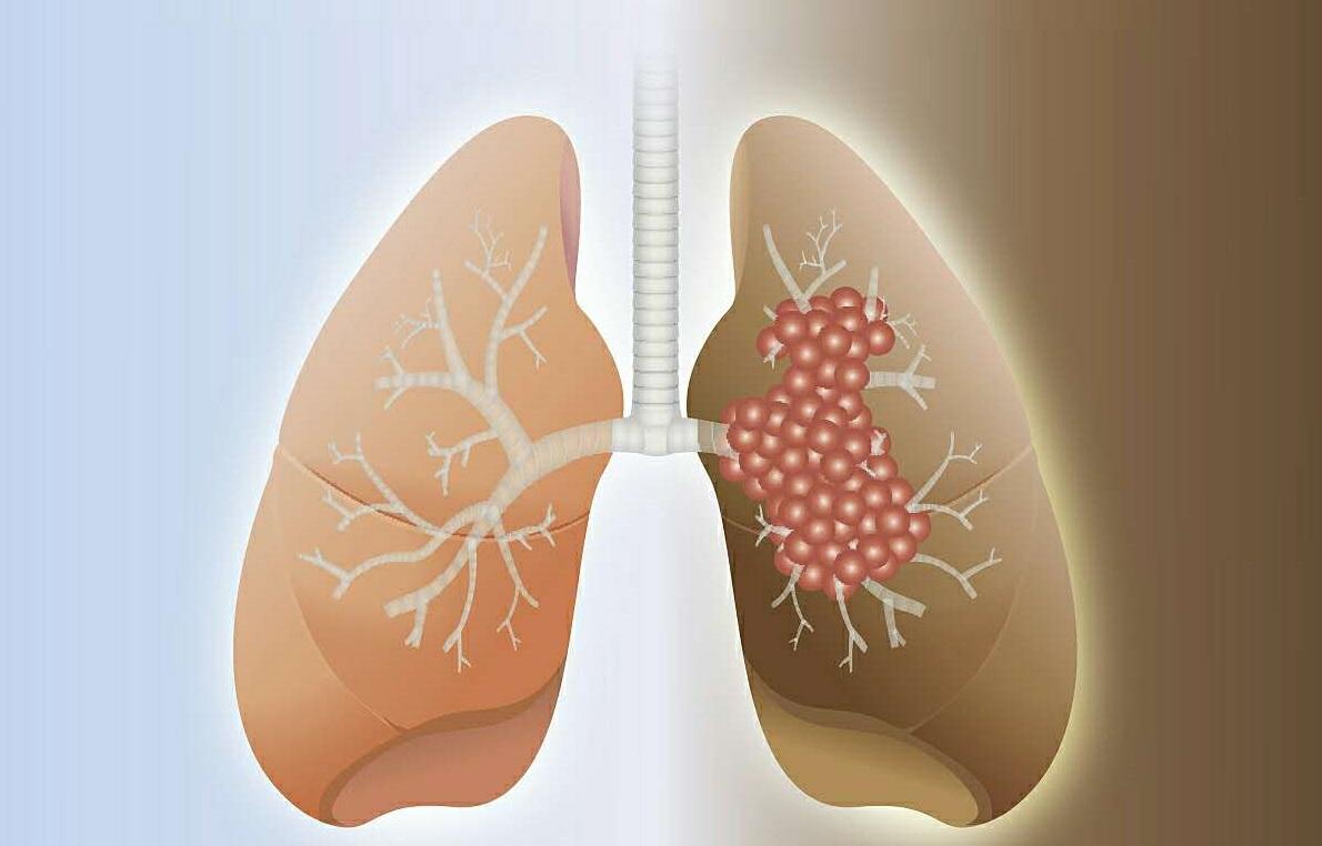 重庆治疗肺癌哪个医院好呢
